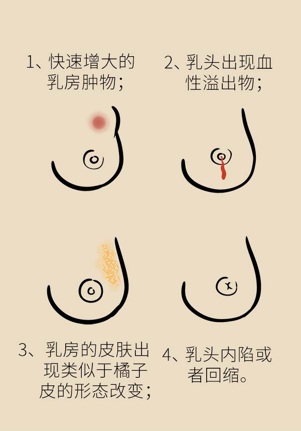 乳腺癌发病日趋年轻化 如何早期发现和预防乳腺癌?