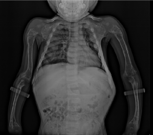 佝偻病孩子的胸骨突出(鸡胸)